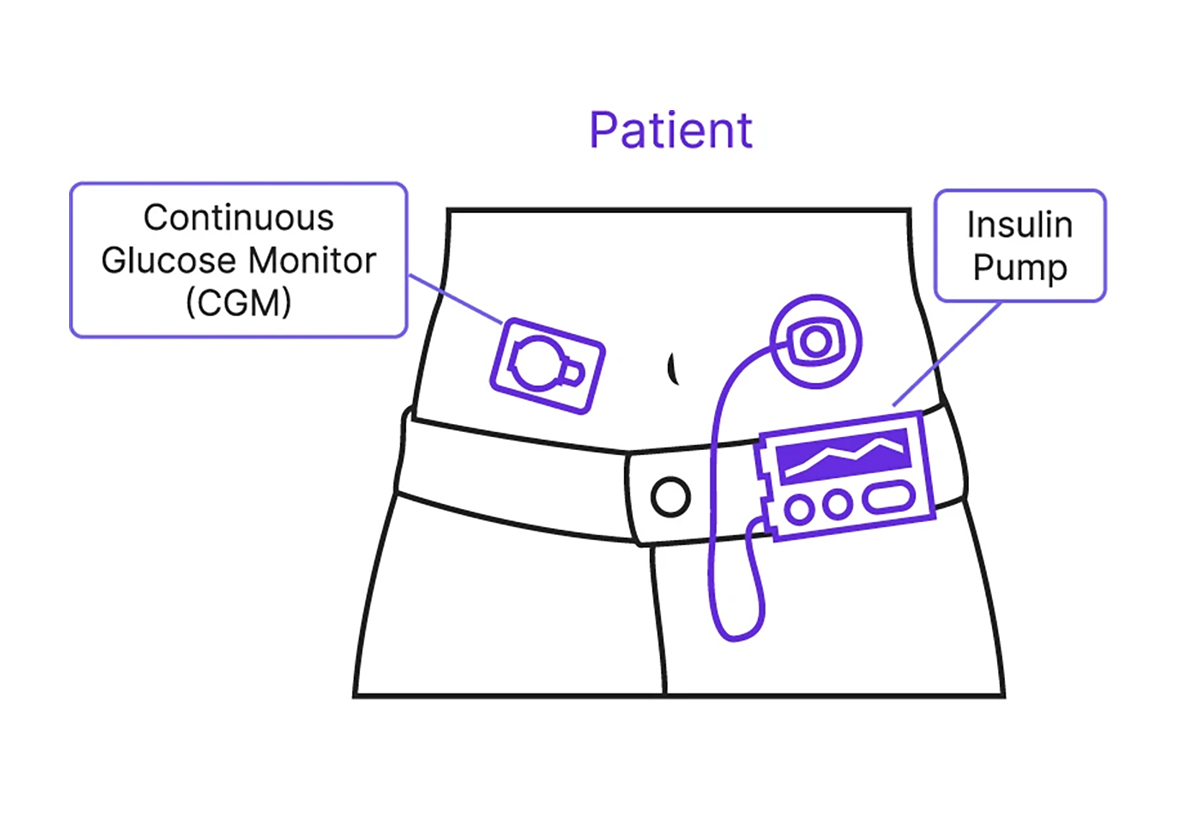 Multimodal Deep Learning Model for Diabetes Hyperglycemic Prediction
